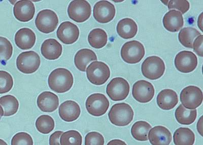 Image of blood from a sickle cell patient after treatment