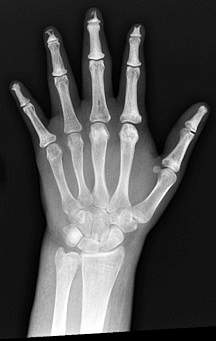 X-ray photo showing tissue loss in fingertips