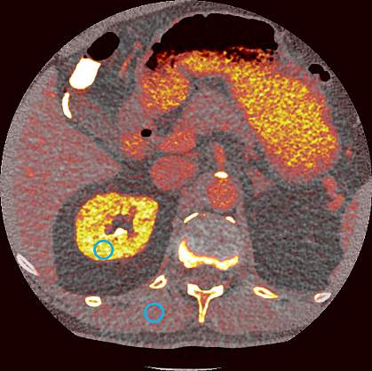 Image of photon-counting CT scan