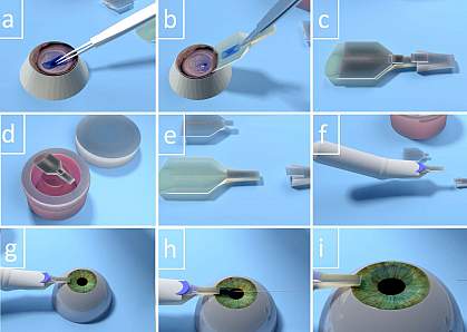 The image shows an illustration of the cornea being folded, placed in the Treyetech device, and loaded into an eye in 9 steps.