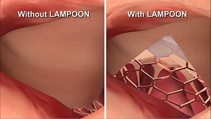 Illustration showing a transcatheter mitral valve implantation with and without LAMPOON.