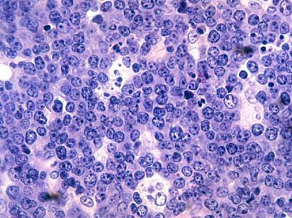 Burkitt’s lymphoma under the microscope