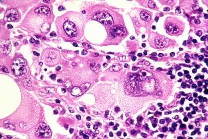 Microscopic image of a melanoma