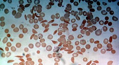 Microscope image of abnormally-shaped blood cells taken from a patient with sickle cell disease