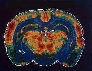 Brain scans showing healthy brain on top nicotine brains on the bottom