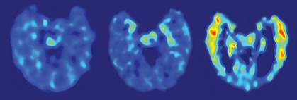Brain images from a healthy person, one with mild cognitive impairment and one with Alzheimer’s disease, each showing progressively larger areas of red and yellow