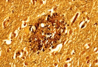 Darker orange/brown material in a section of human brain tissue