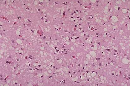 Section of pink brain tissue is riddled with white holes