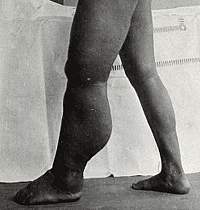 Photograph of legs, with left leg extremely swollen