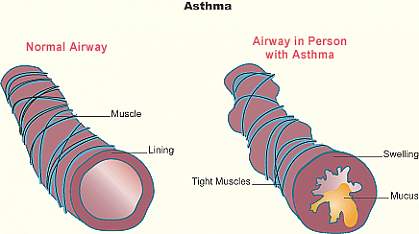 Illustration shows a normal lung tubule and an asthmatic tubule, with a central airway narrowed by tight muscles, swelling and mucus