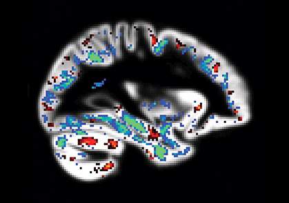 Image of brain with scattered, small areas of color