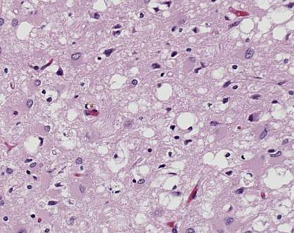 Pink stained brain tissue riddled with white holes