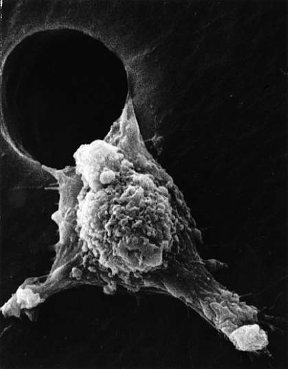 Scanning electron micrograph of cancer cell