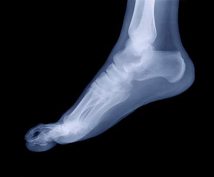X-ray image of a human foot