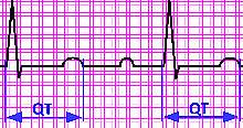 Illustration of an EKG graph showing the QT interval.