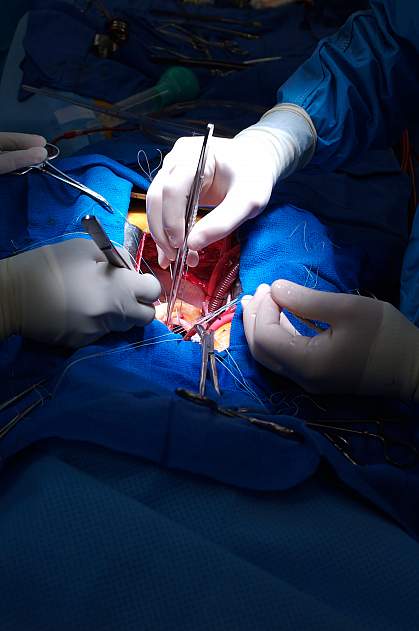 Photo of heart surgery