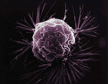 Close-up photo of a breast cancer cell