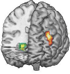 Image of Functional MRI data superimposed on 3-D MRI reconstruction of the brain