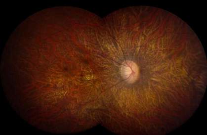 Photo of a retina