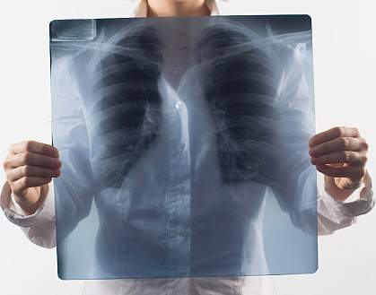 Photo of a lung x-ray held in front of a woman's chest