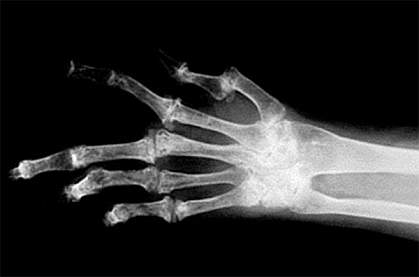 x-ray image of a human hand with several bent fingers