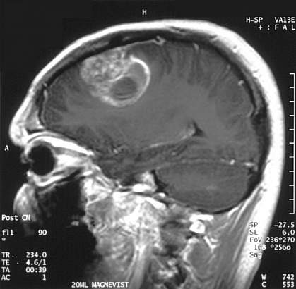 Brain MRI showing bright mass