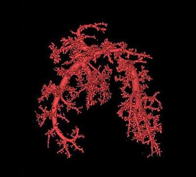 Image of blood vessels in lung