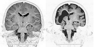 Images of 2 brain scans; the one on the right is smaller with deeper folds and a large central hole.
