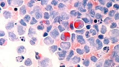 Image of human cells with acute myeloid leukemia