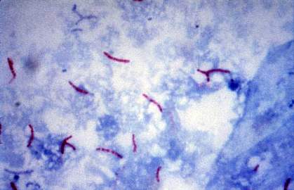 Microscopic image of rod-shaped TB bacteria.