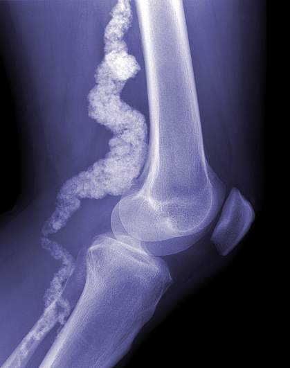 X-ray photo of a knee