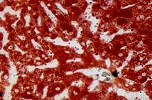 Two microscope images of liver, the left one heavily marbled with red