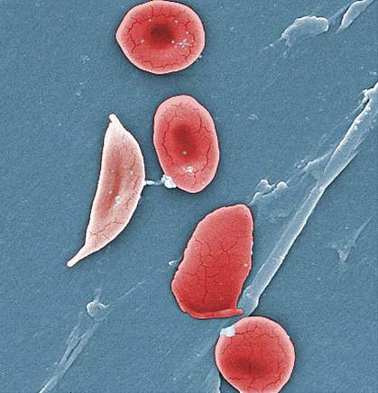 lectron micrograph of a sickle shaped cell on the left and several rounded cells on the right.