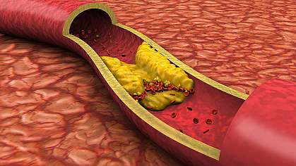 Illustration shows an open artery with a yellow fatty deposit.