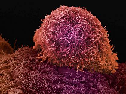 Scanning electron micrograph of a prostate cancer cell