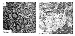 Photos showing cross sections of normal brain on left and abnormal brain on right.