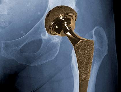 Hip showing metal-on-metal implant