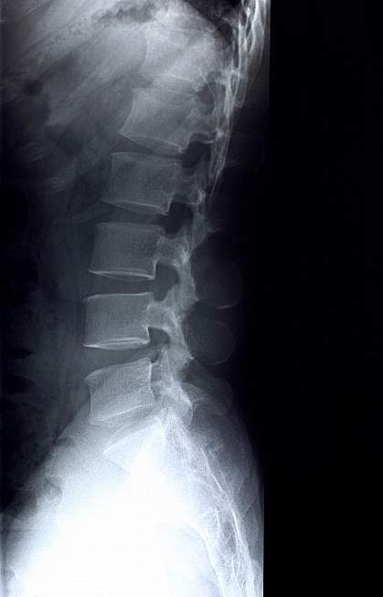 X-ray of lumbar spine.