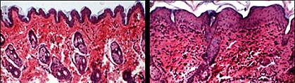 Two microscopic images of mouse skin, one normal and one inflamed.