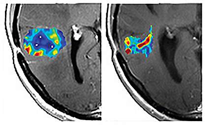 Left brain MRI shows larger area of color than the right.