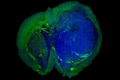 Tumor in a mouse brain.