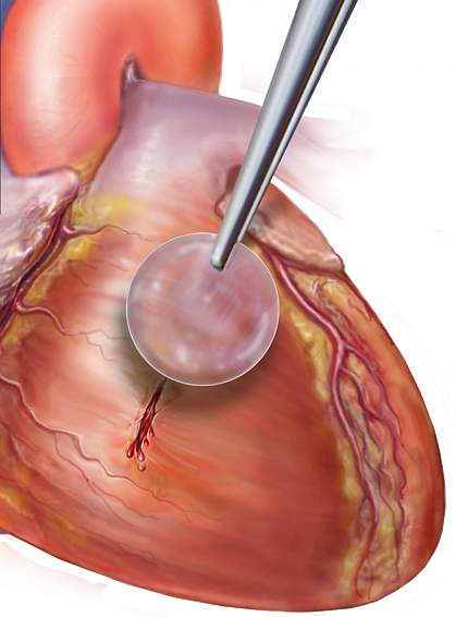 Illustration of patch being applied to heart tissue.