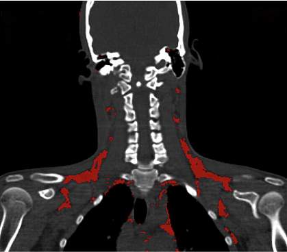 Brown fat tissue in neck area.