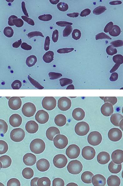 Sickle-shaped blood cells in top panel and round cells in bottom panel.