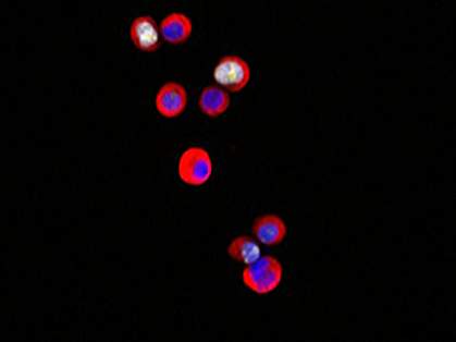 Tumor cells color red and blue.