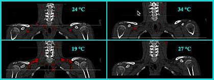 Brown fat in neck and upper back region.