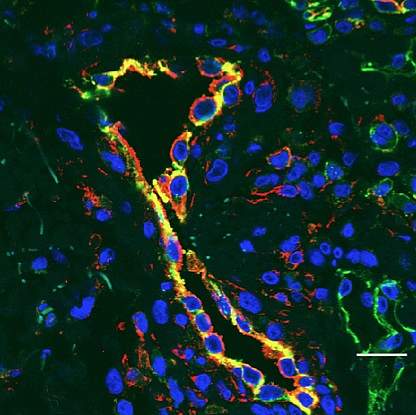 Inflamed blood vessels.