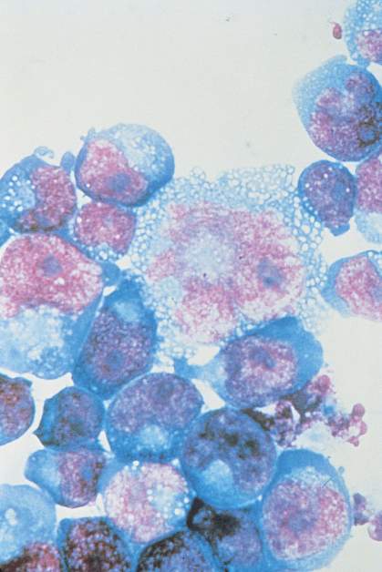 HIV-infected cells.