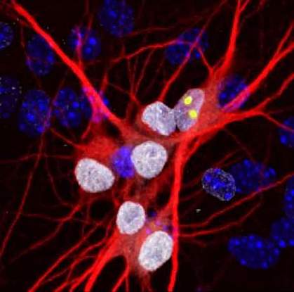 Neurons from an ALS patient