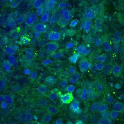 Brain tumor tissue with cells in a disordered pattern.